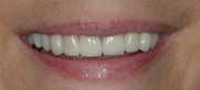 After Veneers